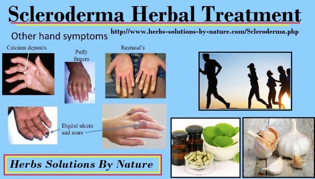 Scleroderma Herbal Treatment with Herbal Supplement